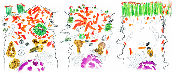 Pencil drawing of two diseased and a healthy enterocyte. Different cellular structures are shaded in different colors. Most important are the microvilli. The healthy enterocyte shows tall, brush border microvilli (green) pointing up and tipped with orange. There are a few speckles of orange throughout the cell (“secretory granules”). The diseased enterocytes show very few microvilli on the apical surface of the cells, and, where present, are shorter than in the healthy cell. There is a lot more orange in the diseased cells. The MVID cells also have clumps of microvilli on the inside.