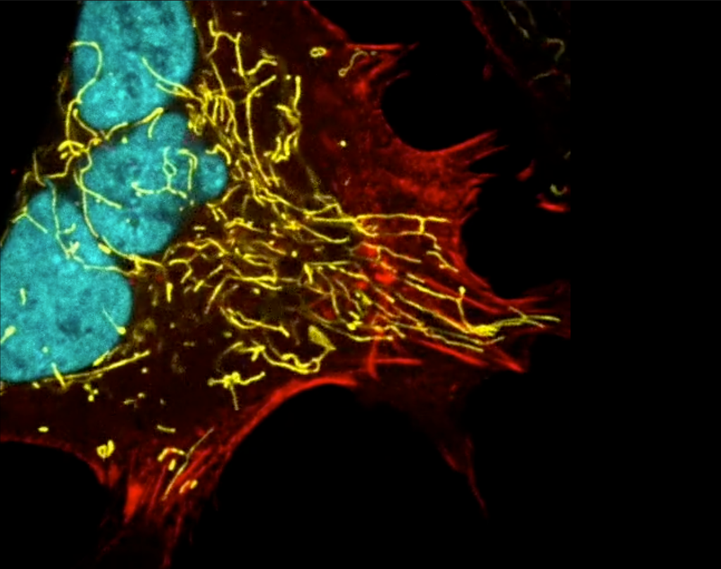 A cancer cell stained in red and yellow with three nuclei (cyan).