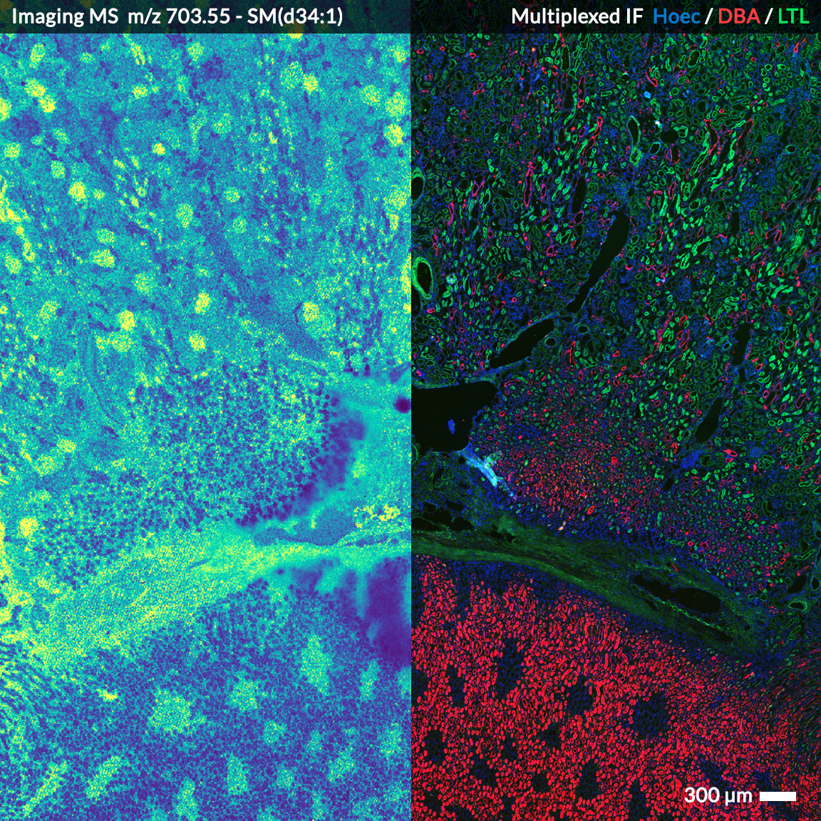 The same image of a section of human kidney tissue, split in half, with the left half of the image looking mostly blue with green/teal speckles, and the right half having blue, red, and green speckles throughout..