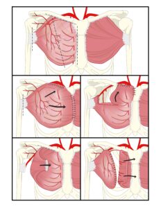 Graphics illustrate chest wall reconstruction in five phases.